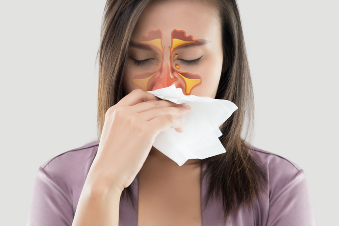 Sinusitis – Ayurvedic Line of Management