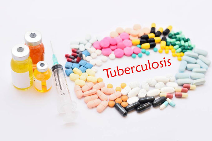 Tuberculosis Uncovered: A Comprehensive Guide to Causes, Symptoms, Treatment, and Prevention